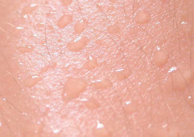 Schwei Bromhidrosis Krankhafter Schwei geruch schwei-bromhidrosis-krankhafter-schwei-geruch